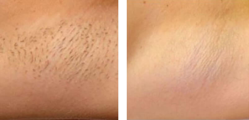 Laser Hair Removal Rochester Medway Kent